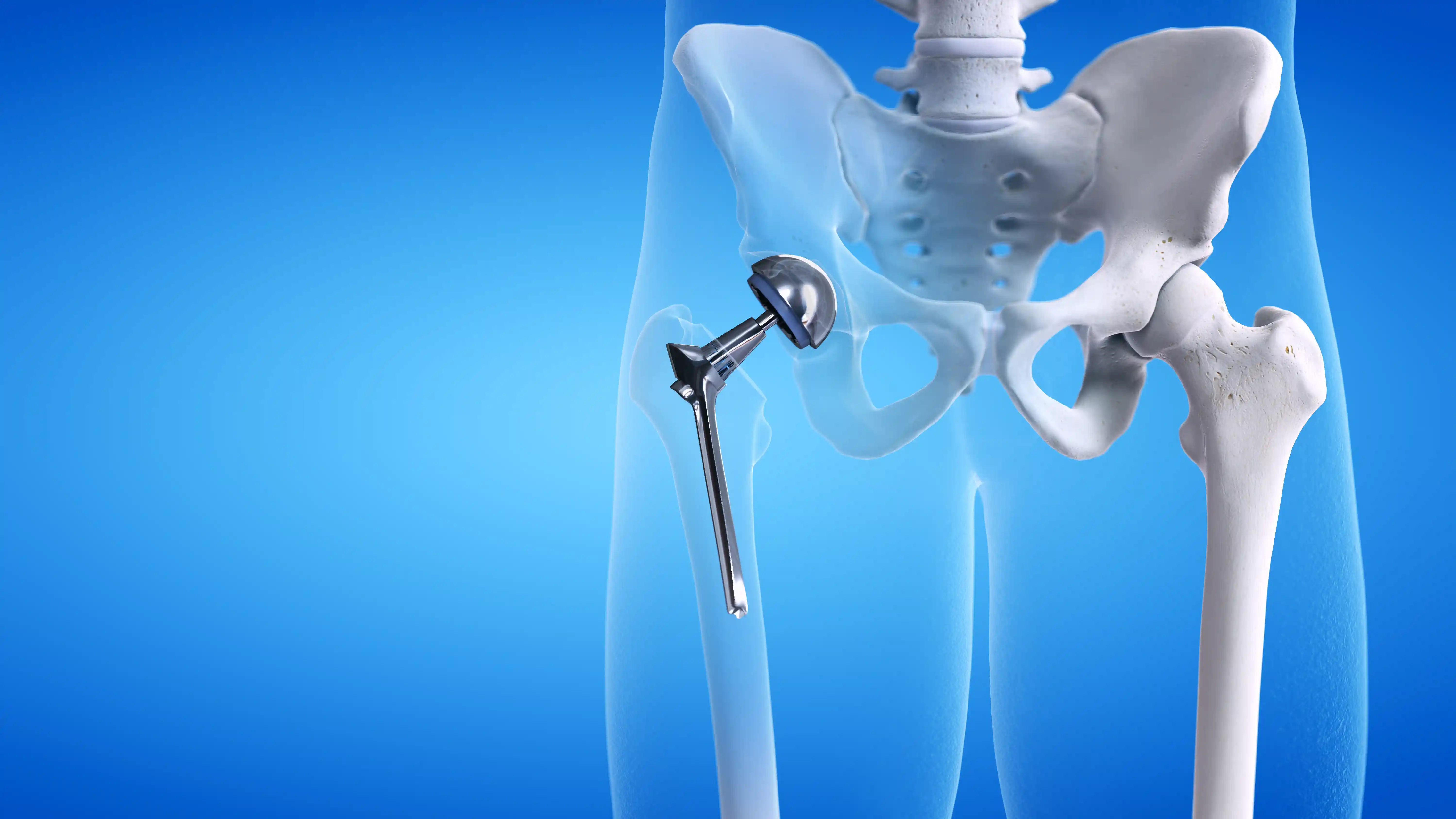 Hip Replacement