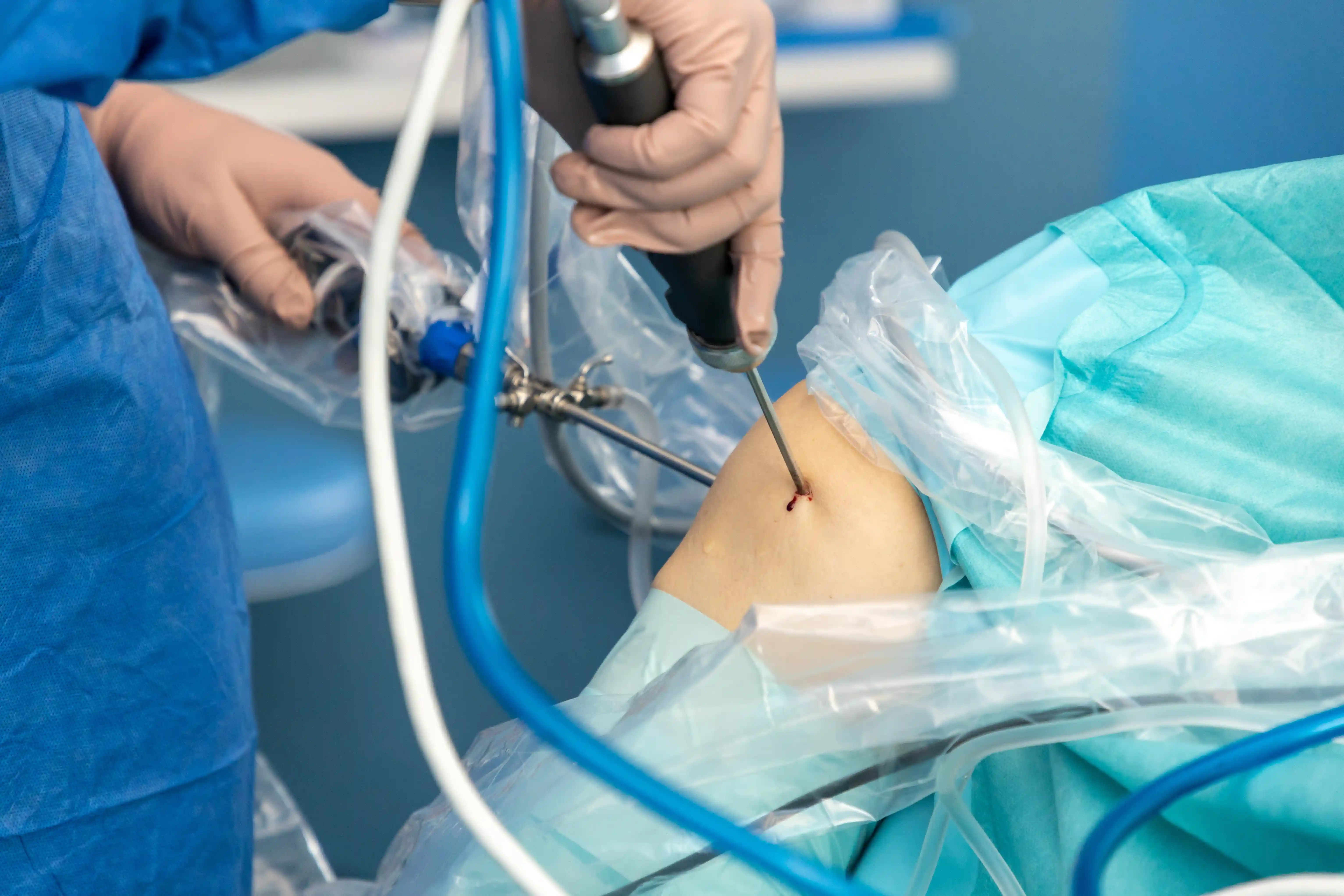 Knee Arthroscopy